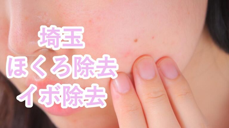 埼玉・大宮・浦和のほくろ