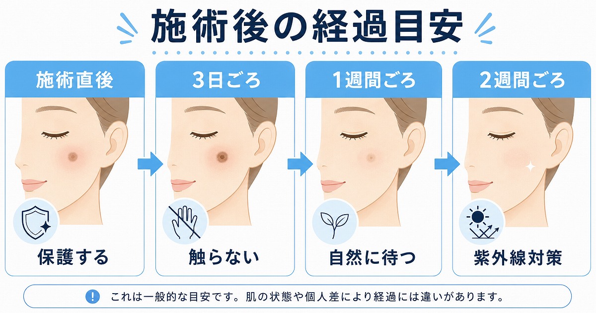 シミ取りレーザー施術後の経過